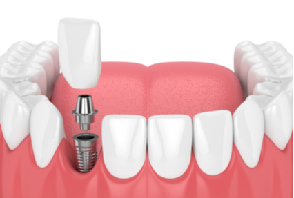 dental implant illustration.