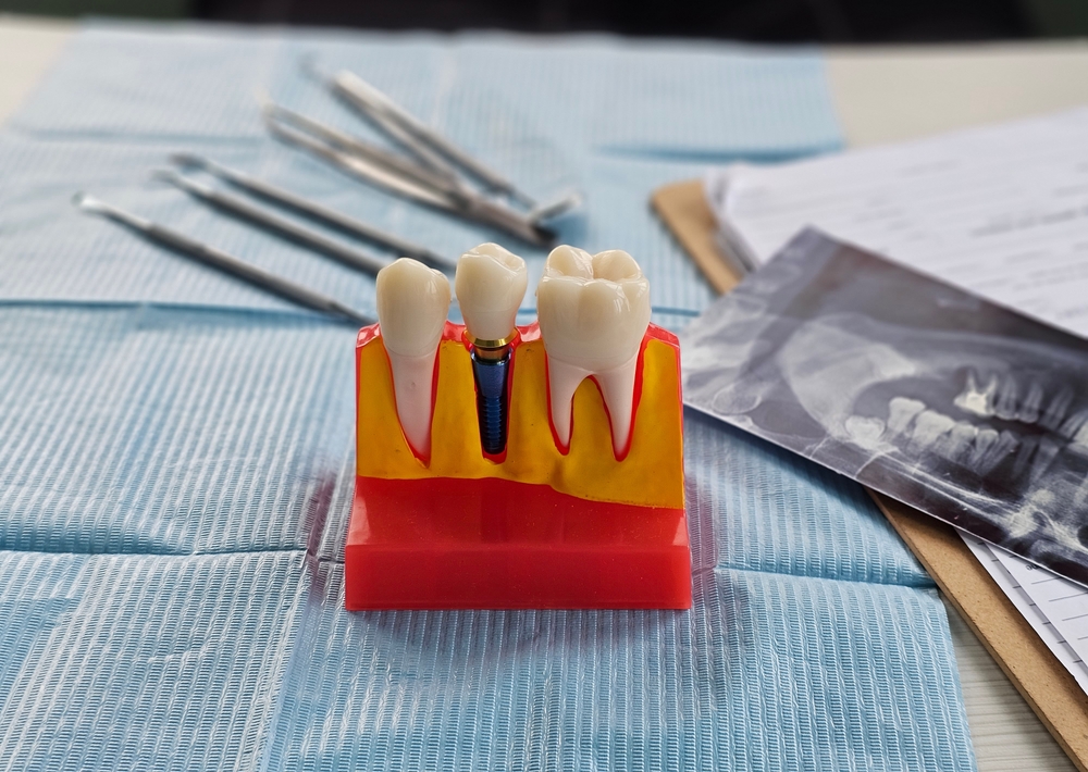 Model of a dental implant beside dental instruments and an X-ray
